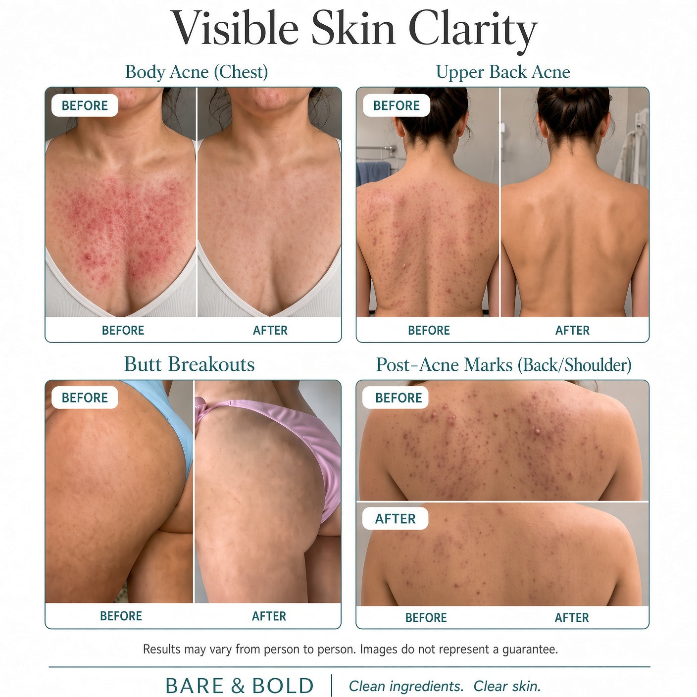 Bare & Bold Body Acne Serum 15% Mandelic Acid